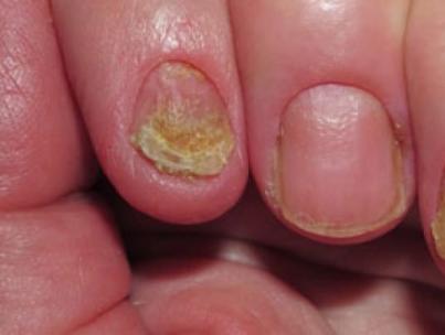 Tratamiento de hongos avanzados en uñas y piel Tratamiento de hongos avanzados en uñas de los pies con remedios caseros