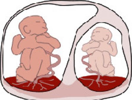 Síndrome de transfusión feto-fetal en gemelos: clasificación y opciones de tratamiento