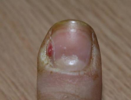 Panaritium del dedo periungueal de la mano y el pie: síntomas, causas, complicaciones, tratamiento.